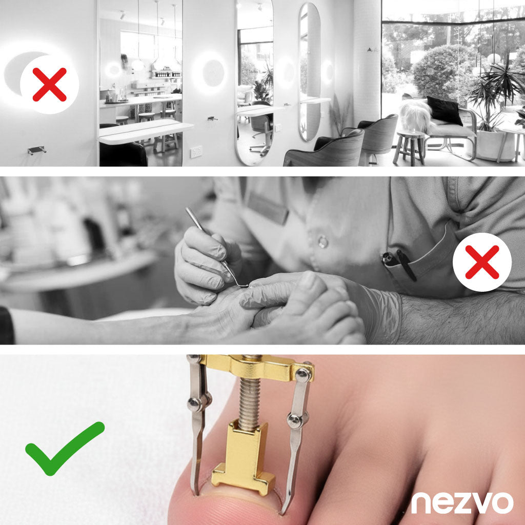 Correcteur D’Ongles Incarnés – Soulagement Et Soin Efficace