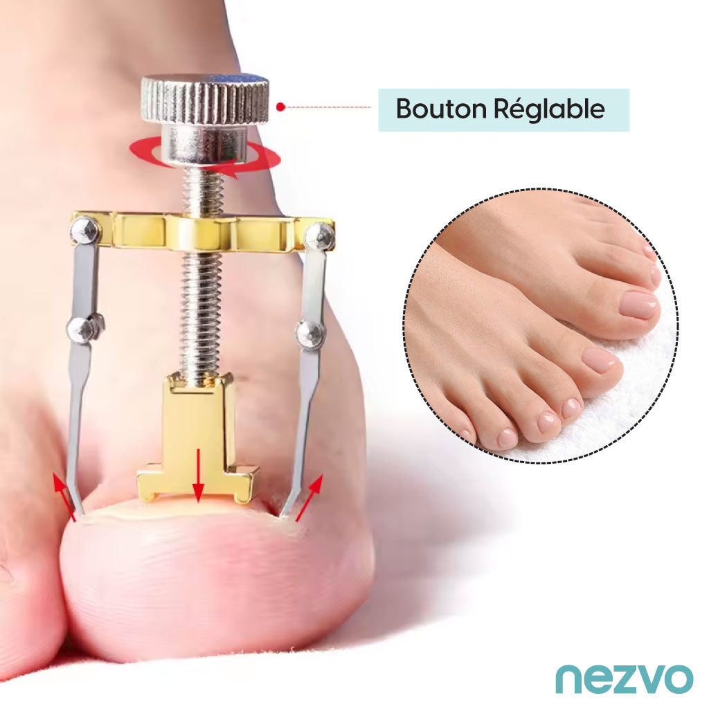 Correcteur D’Ongles Incarnés – Soulagement Et Soin Efficace