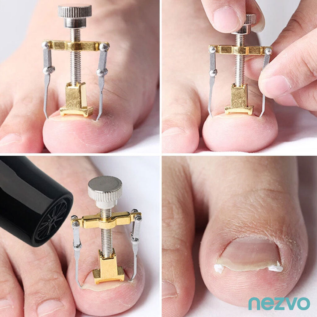 Correcteur D’Ongles Incarnés – Soulagement Et Soin Efficace