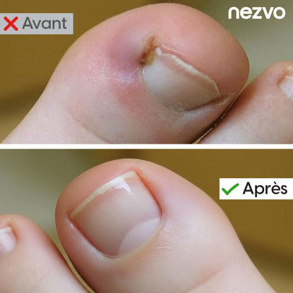 Correcteur D’Ongles Incarnés – Soulagement Et Soin Efficace